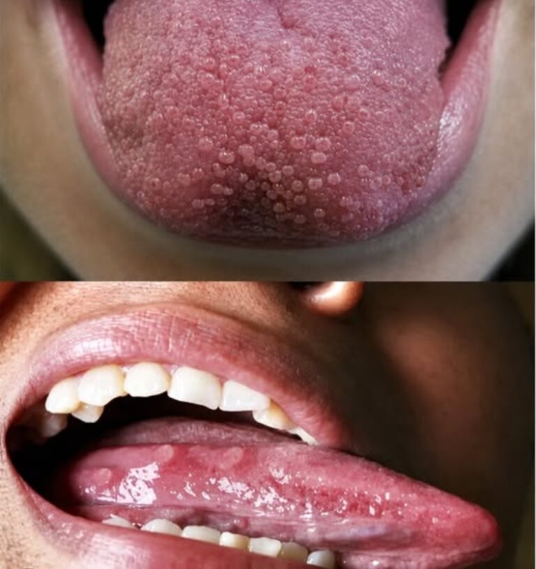 ¿Por qué tengo la lengua blanca? Lo que tu cuerpo quiere decirte